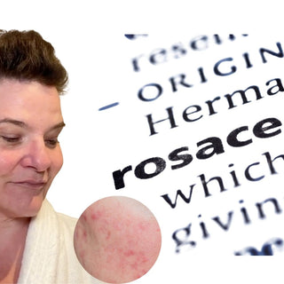 rosacea